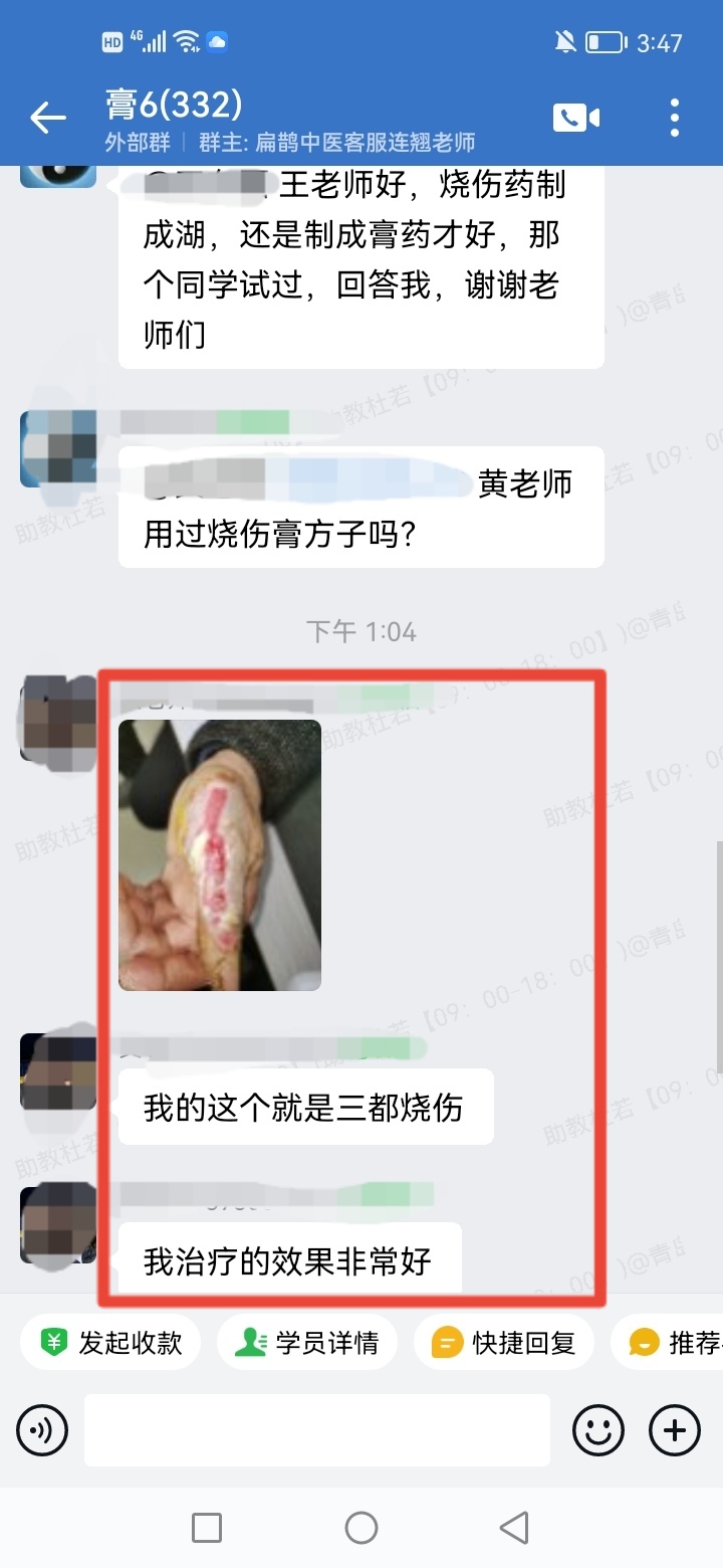 王氏透皮外调技术学员反馈：患者三度烧伤，用了王老师的烧伤膏，效果非常好！