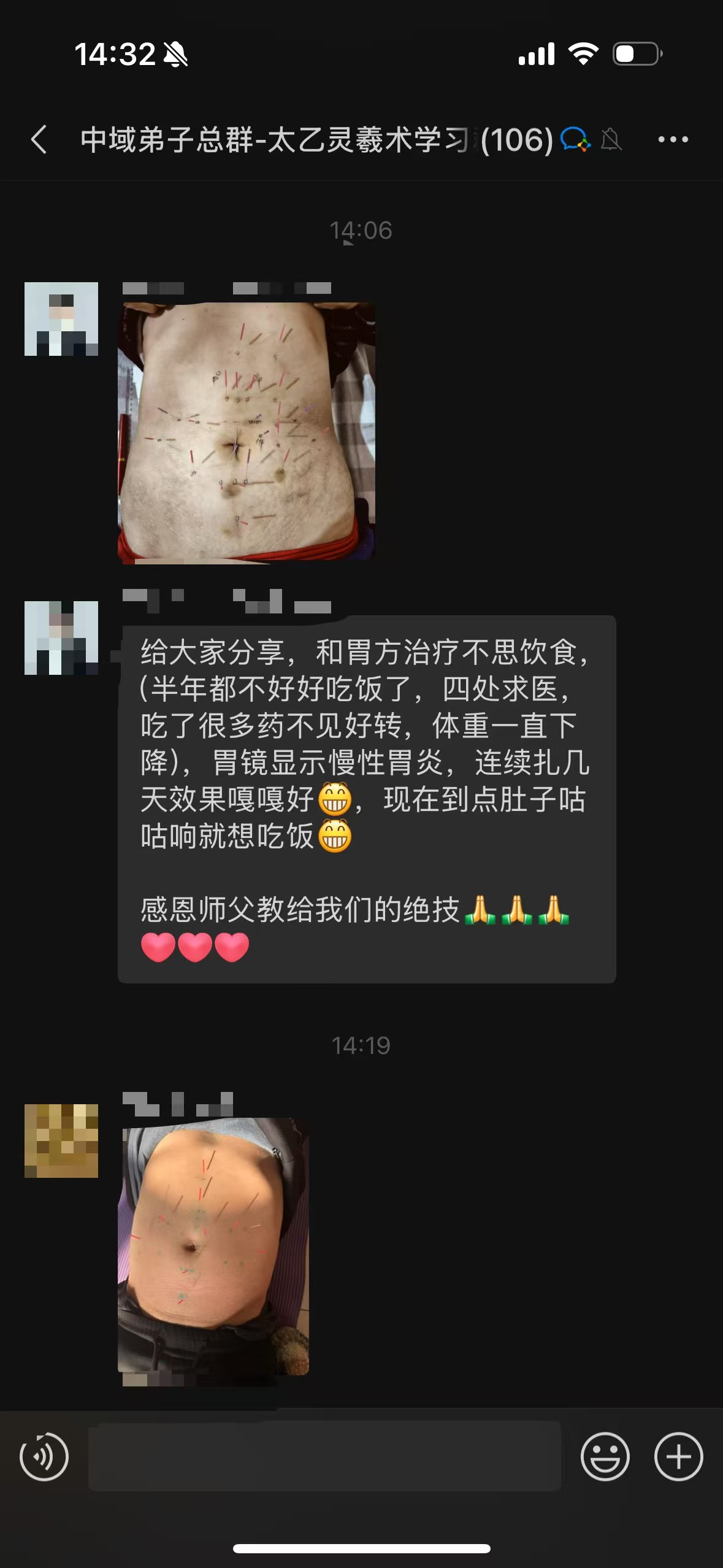 太乙灵羲术弟子反馈：无痛针灸**不思饮食，现在到点就想吃饭！