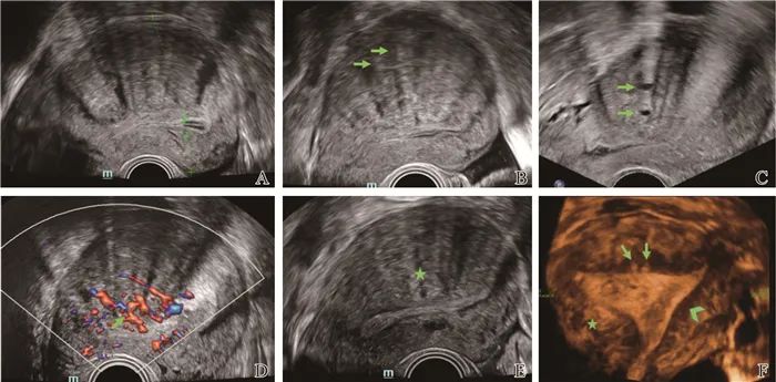 子宫腺肌病的超声与MRI诊断及进展